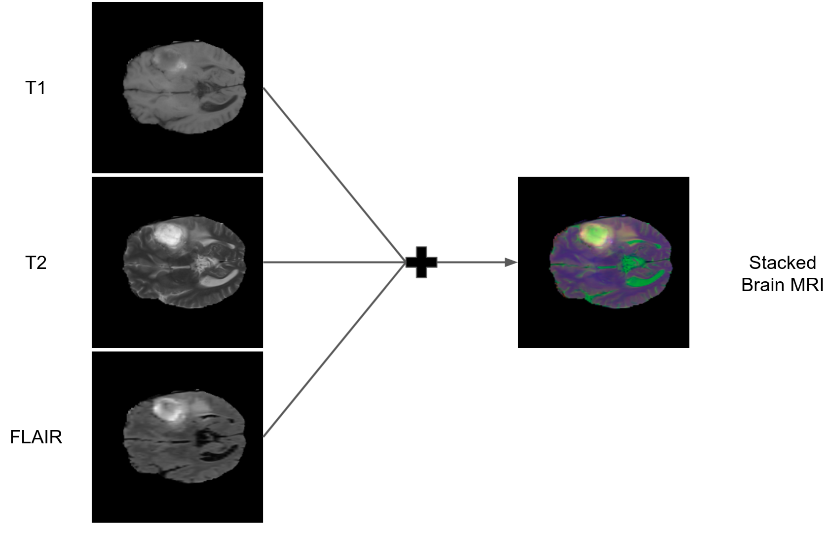 T1, T2, FLAIR-Stacked Brain MRI Generation using StyleGAN2