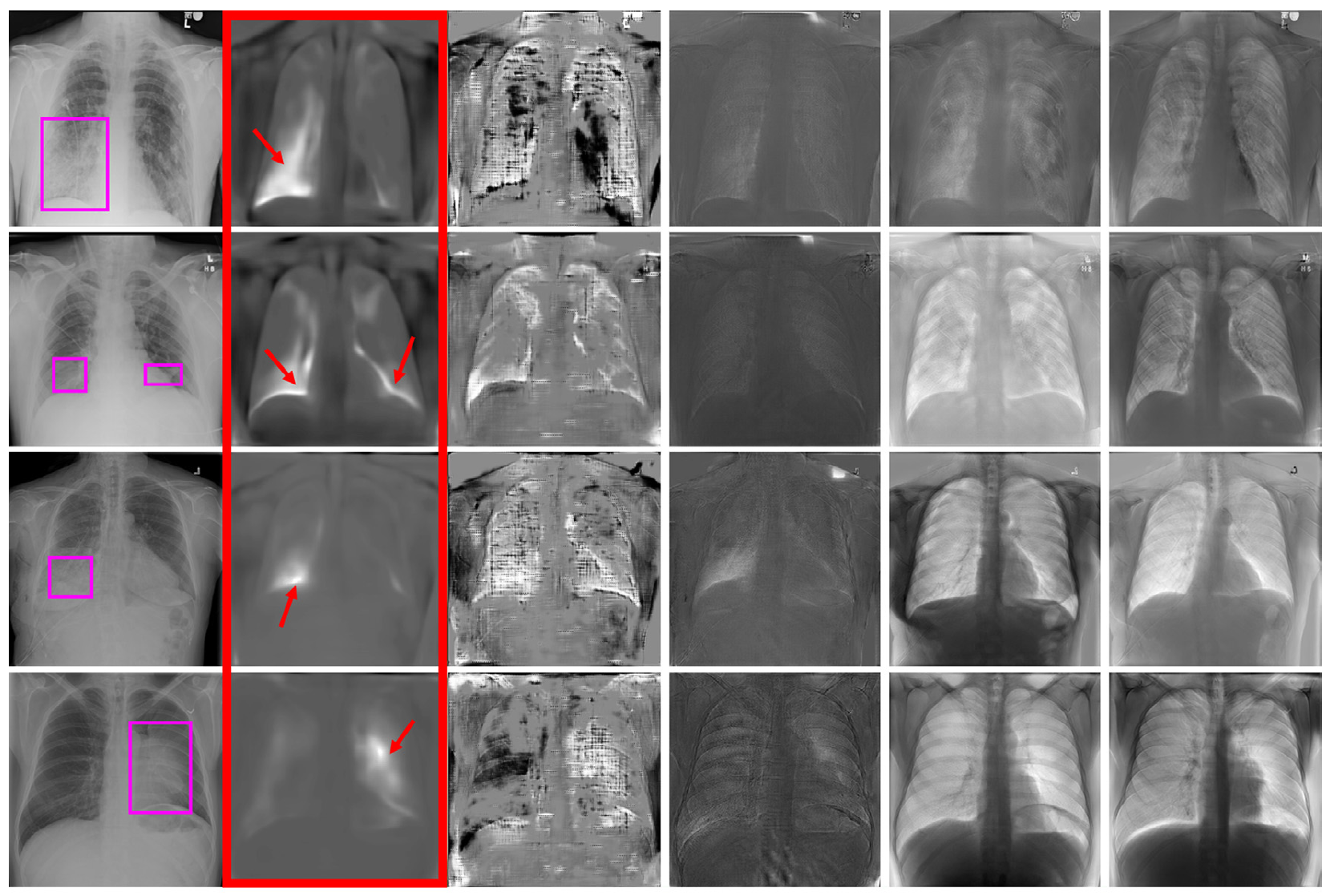 [Paper Review] A disentangled generative model for disease decomposition in chest X-rays via normal image synthesis_2편